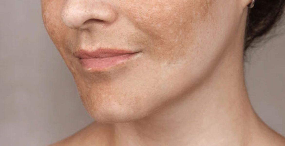 Pigmentation-image