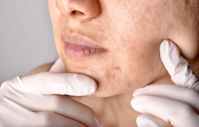 doctor-or-dermatologist-hand-exam-patient-face-2024-12-03-21-31-25-utc-min