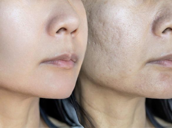 skin-problems-and-acne-scar-before-and-after-acne-2023-11-27-05-08-08-utc-min